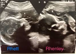 ultra sound